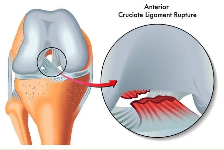 Leaving it allows the ACL to heal