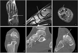 Recognizing the risk of bone strain injuries after wearing shoes with carbon fiber plates