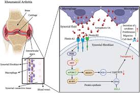 Relevance of circulating semaphorin 4A to rheumatoid arthritis response to treatment