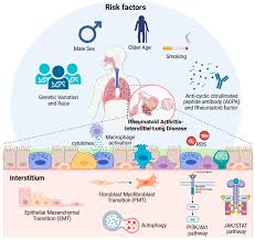 Epidemiology and clinical features of interstitial lung disease in patients with rheumatoid arthritis from the JointMan database