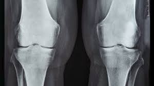 You Don’t Look Sick – Living With Rheumatoid Arthritis: ANOTHER SET OF X-RAYS?