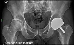 American Hip Institute Research Foundation (AHIRF) – Clinical Research Internship 2023-2024