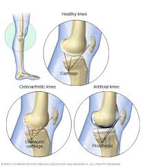 Researchers suggest a new approach to testing treatments for osteoarthritis