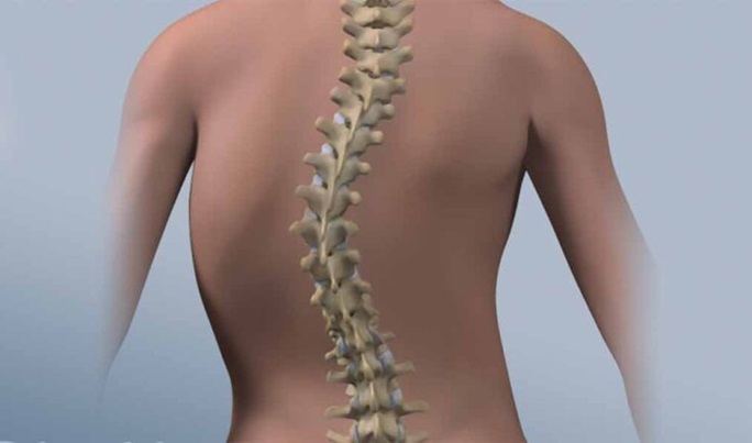 Global Scoliosis Management Market Report 2023: Market to Grow by $1 Billion by 2030 – Spinal Fusion Surgery Offers Major Opportunities