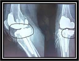 Knee Post-Traumatic Arthritis