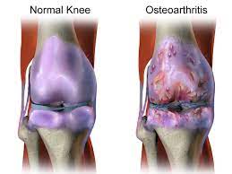 Knee Cartilage Degeneration