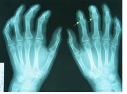 A deep learning system accurately identifies joint space narrowing and erosions on hand X-rays