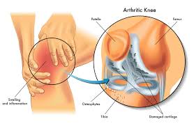 Knee Joint Damage