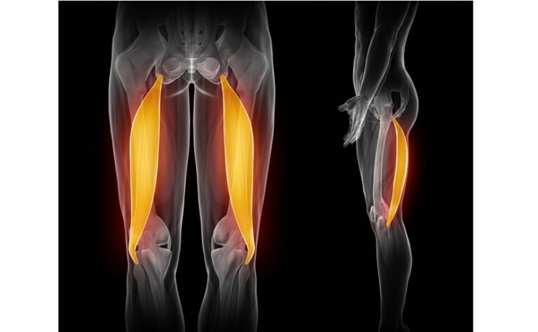 Stronger thigh muscles can prevent knee replacement surgery