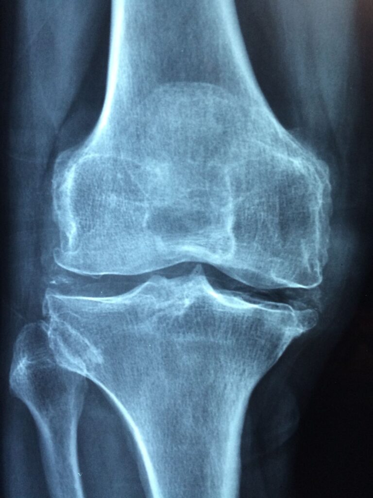 Managing Chronic Knee Pain from Arthritis