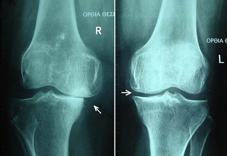 Managing Knee Arthritis: Tips and Treatments