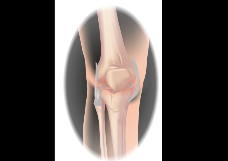 Understanding Knee Pain: Why Does it Pop?