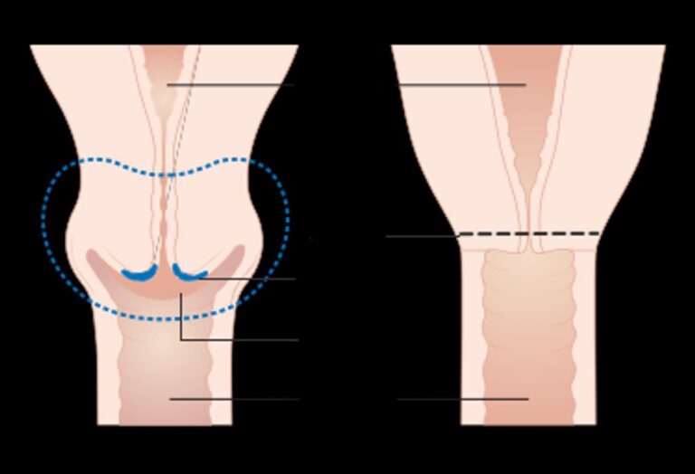 Understanding Artificial Knee Replacement