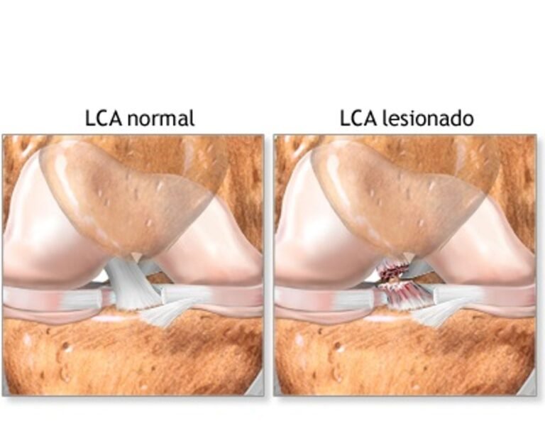 Titanium Knee Replacement: Benefits and Considerations