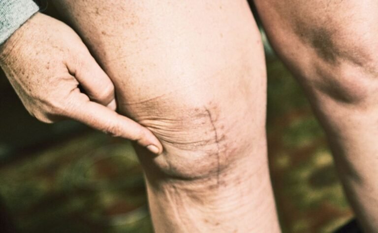 Managing Hypermobile Knees: What You Need to Know