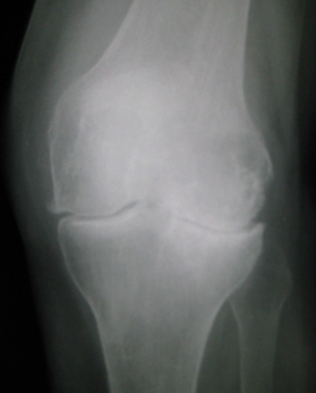 Hylan G-F 20: A Promising Treatment for Osteoarthritis Knee