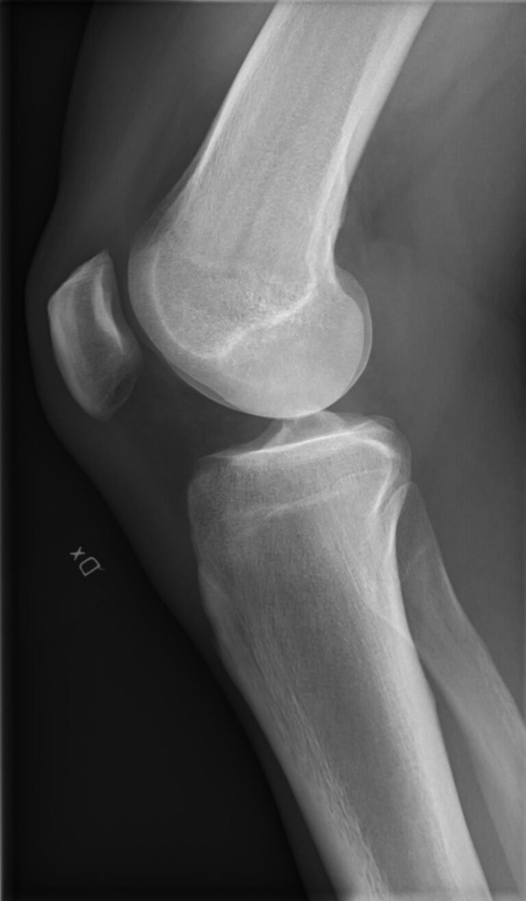 The Importance of Knee Bones in Joint Health