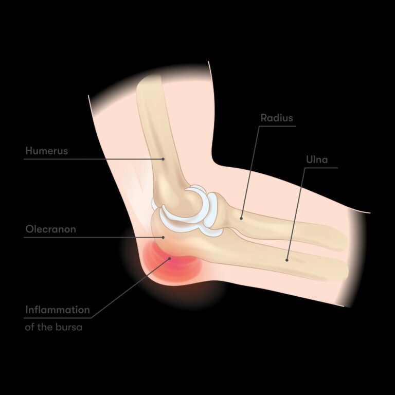 Understanding Meniscus Tear Pain: Symptoms and Treatment Options