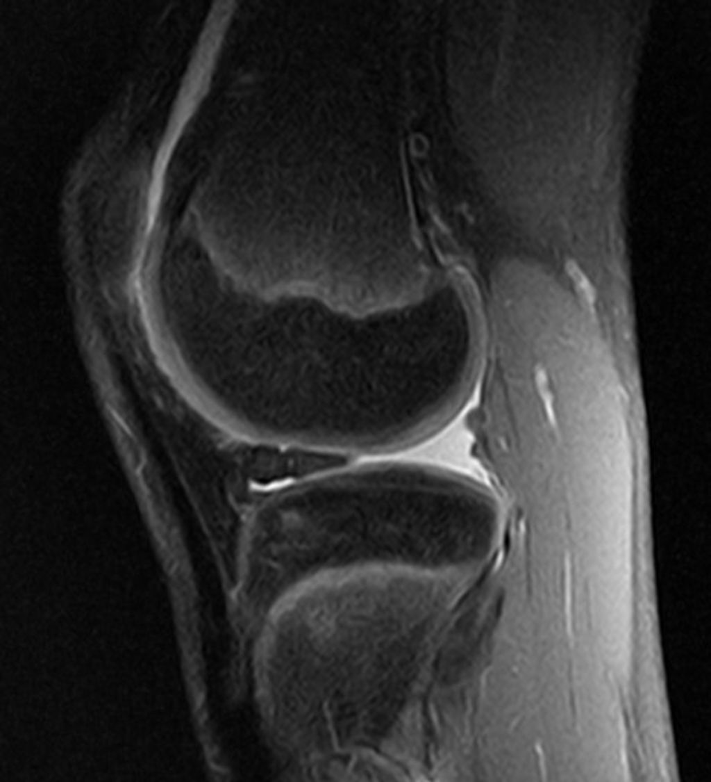 Medial and Lateral Meniscus Injuries: What You Need to Know