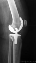 Managing Inverted Knees: Treatment Options - Knee Hurt