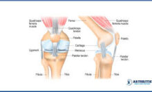 Understanding Patella Pain When Straightening Leg