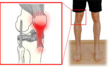 Patellar Tendonitis