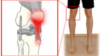 Overcome Patellar Tendonitis – Effective Tips
