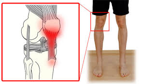 Overcome Patellar Tendonitis – Effective Tips