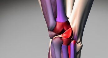 Understanding Lateral Patella Dislocations