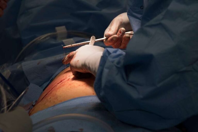 The Process of Knee Joint Replacement Explained