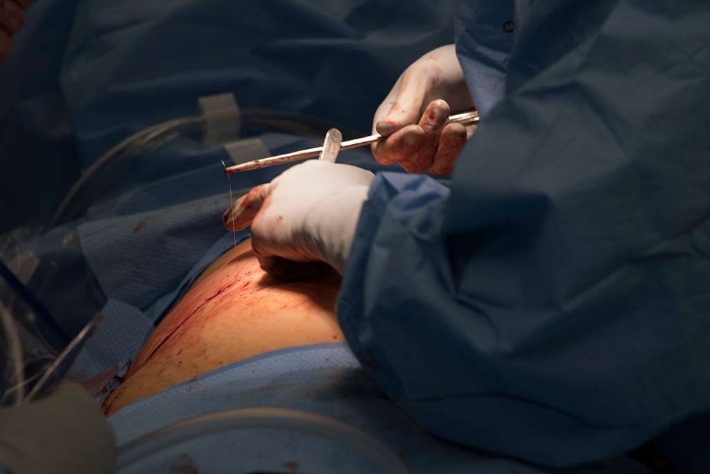 The Process of Knee Joint Replacement Explained