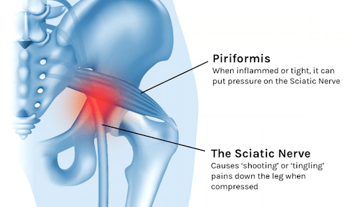 Piriformis Syndrome Is a Pain in the Butt: Understand the Causes, Symptoms, and Stretches to Get Rid of It Fast – ACL Strong