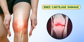 First signs of cartilage wear in knees