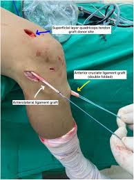 The 'Quad-Plus' ACL Reconstruction Standard 2026: What It Is, Why It Works, and What You Need to Know