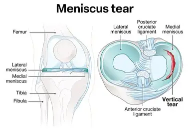 How to Prevent Meniscus Tears During World Cup Training: A Complete Guide for Athletes